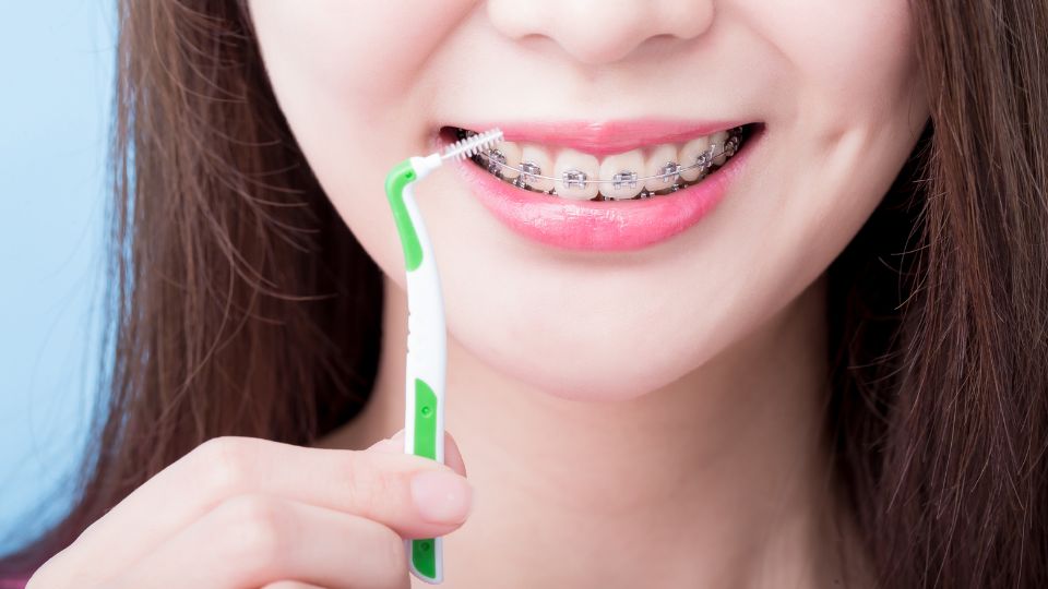 Apparecchio fisso: come pulire i denti in maniera efficace